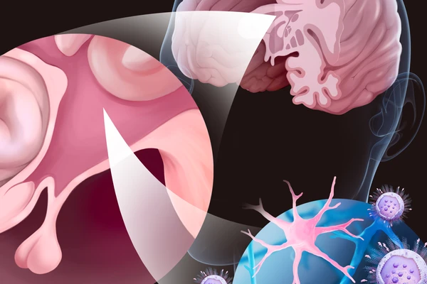 Graphic of brain and drug delivery